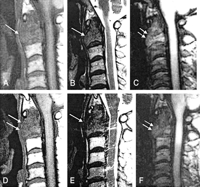 Diffusion Weighted Mr Imaging Of Metastatic Disease Of The Spine