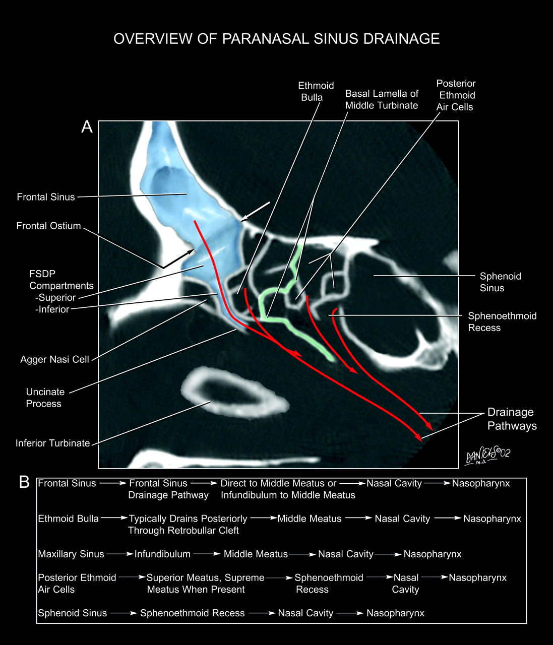 The Frontal Sinus Drainage Pathway and Related Structures | American