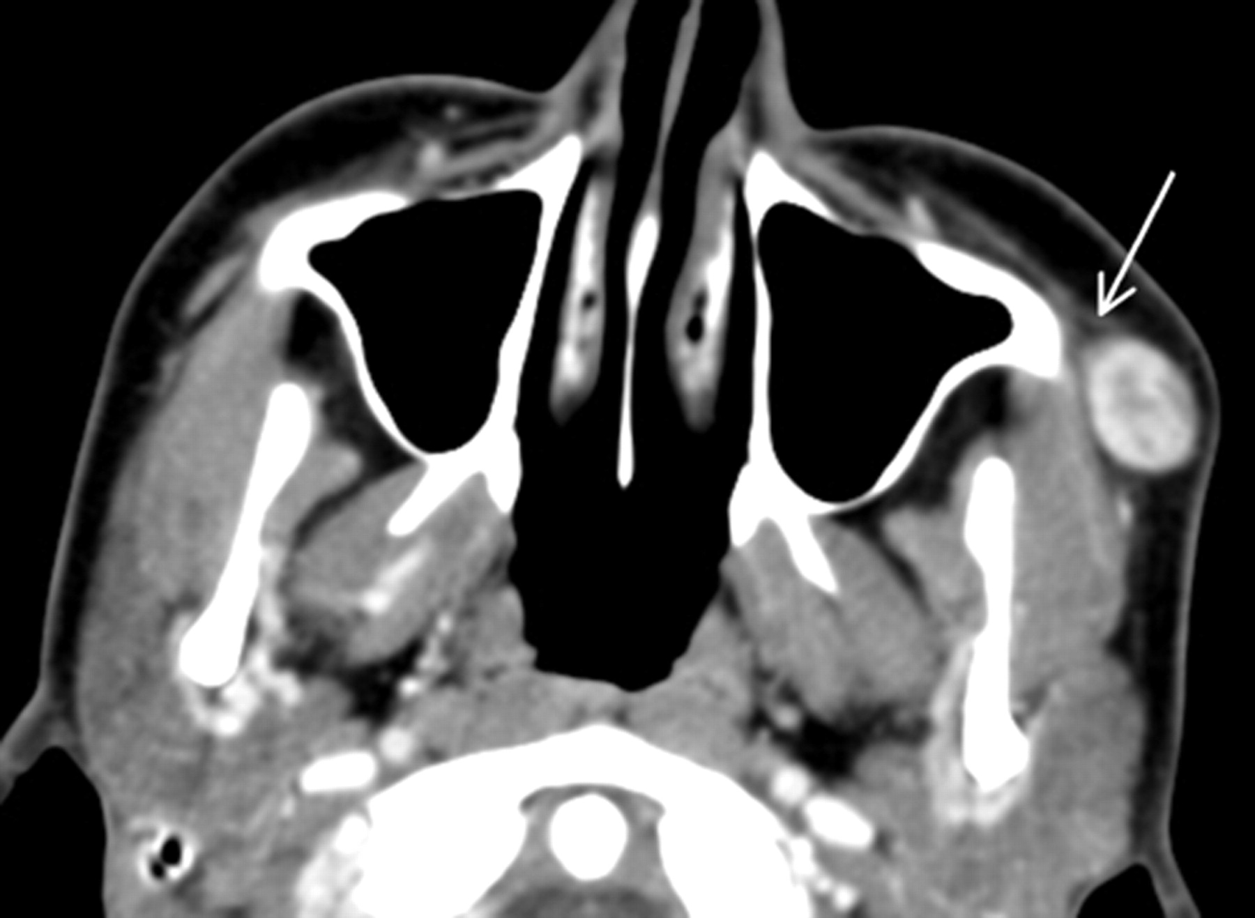 Nodular Fasciitis in the Head and Neck: CT and MR Imaging Findings