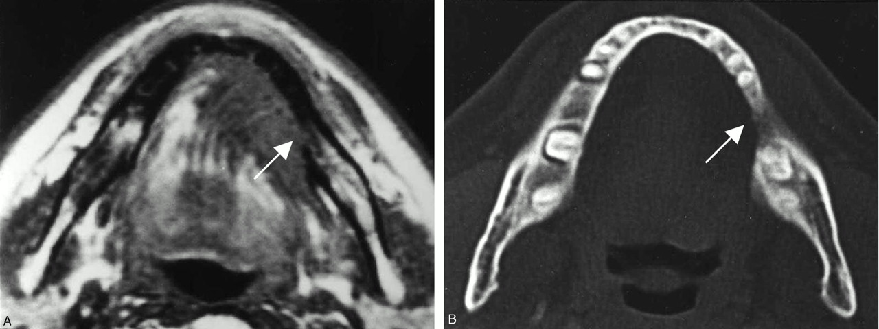 A Potential Pitfall Of Mr Imaging For Assessing Mandibular