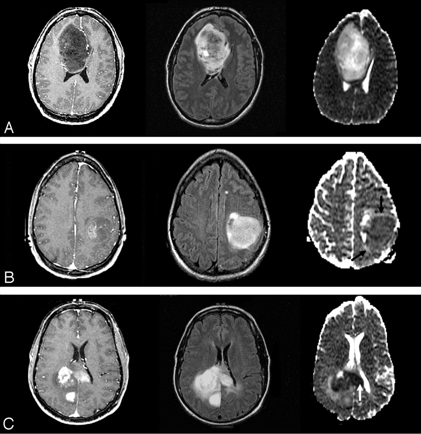 Update On Brain Tumor Imaging From Anatomy To Physiology American 