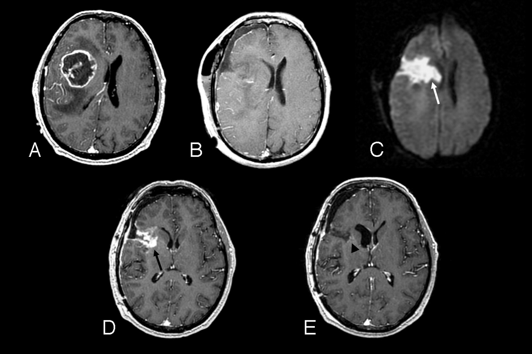 Update on Brain Tumor Imaging: From Anatomy to Physiology | American