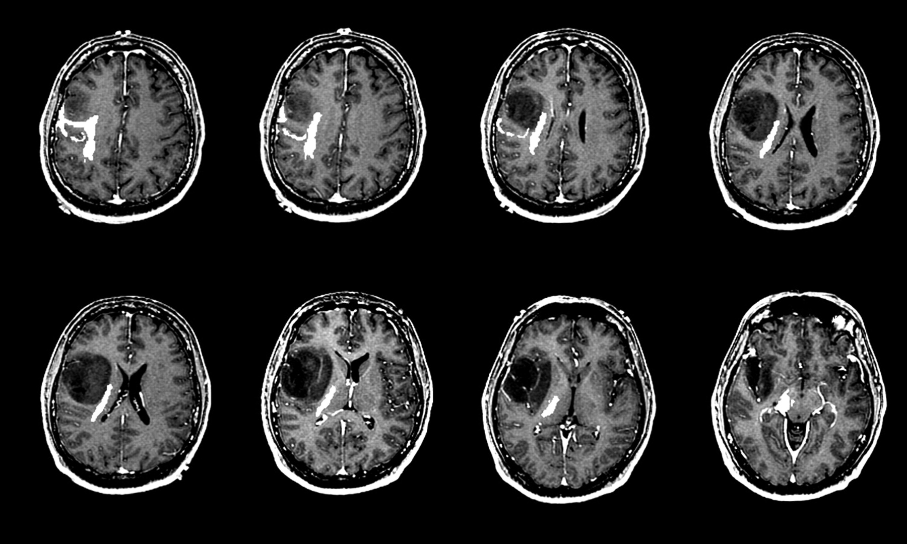 Update On Brain Tumor Imaging From Anatomy To Physiology American 