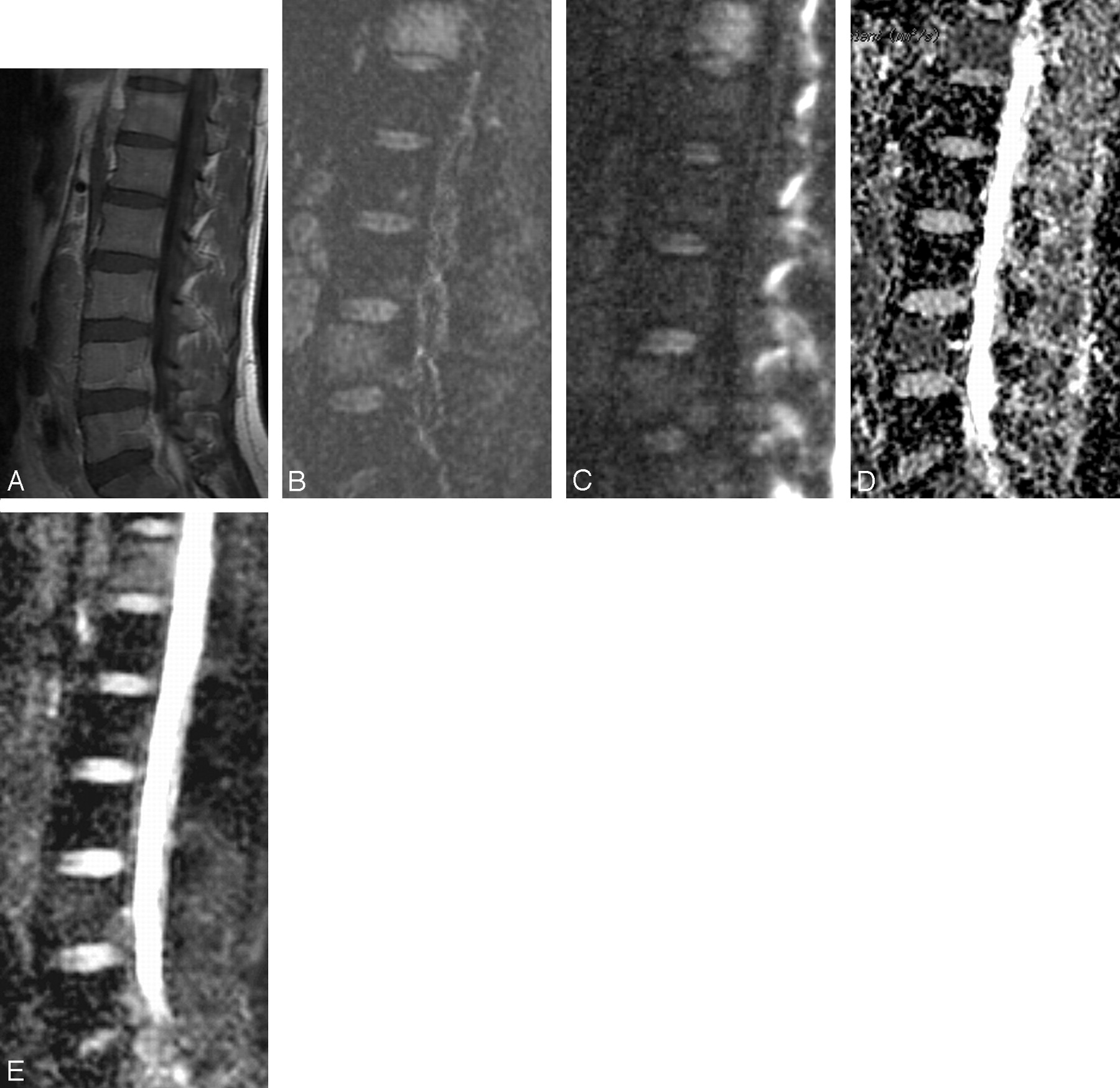 Diffusion Weighted Imaging Of The Spine With A Noncarr Purcell Meiboom