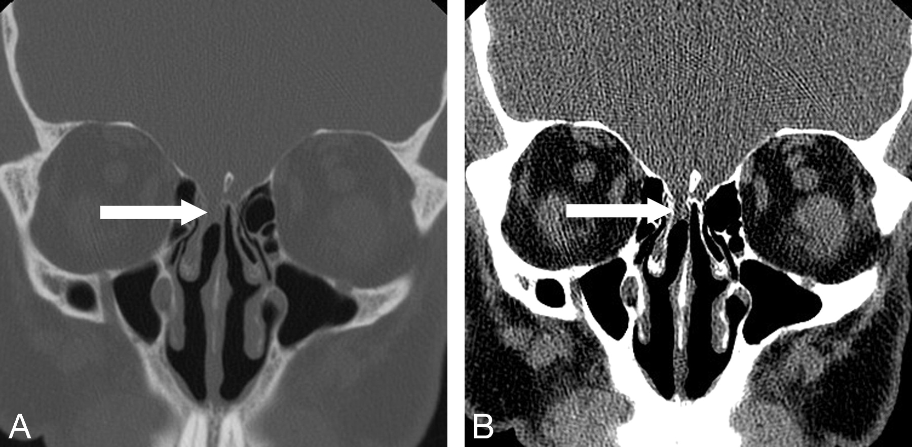 Focal Opacification of the Olfactory Recess on Sinus CT: Just an