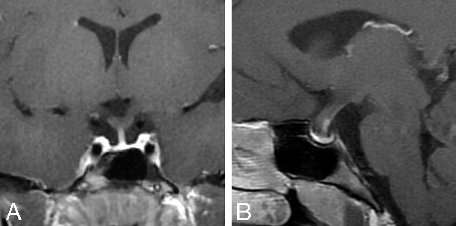 Sequential Pituitary Mr Imaging In Sheehan Syndrome Report Of 2 Cases 5943