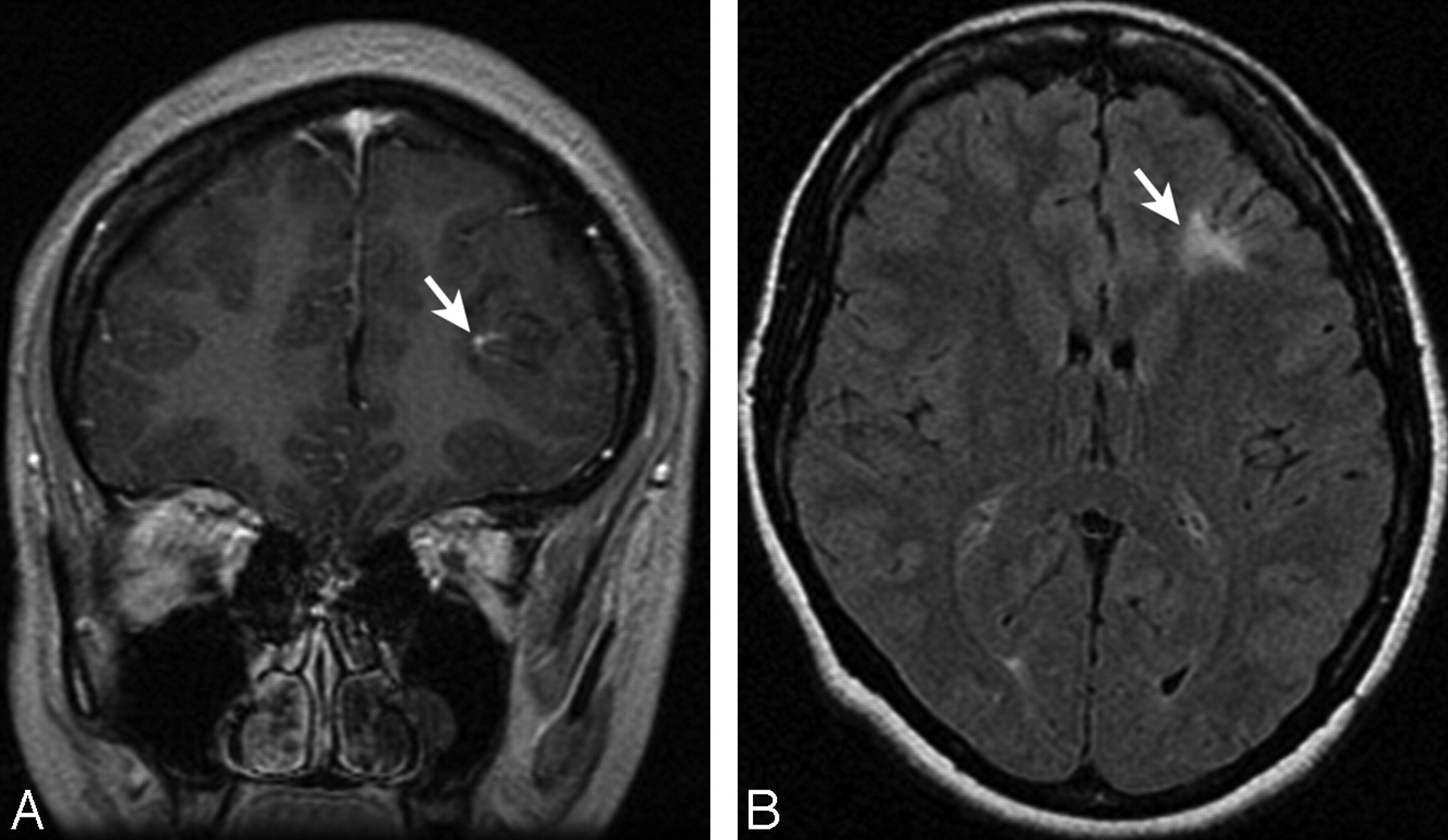 brain-parenchymal-signal-abnormalities-associated-with-developmental