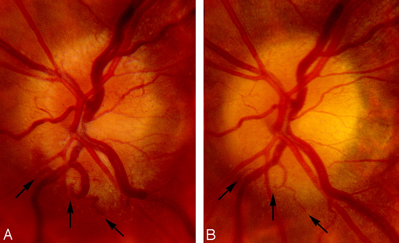 Immediate Shrinkage Of Optociliary Shunt Vessels After Fractionated 