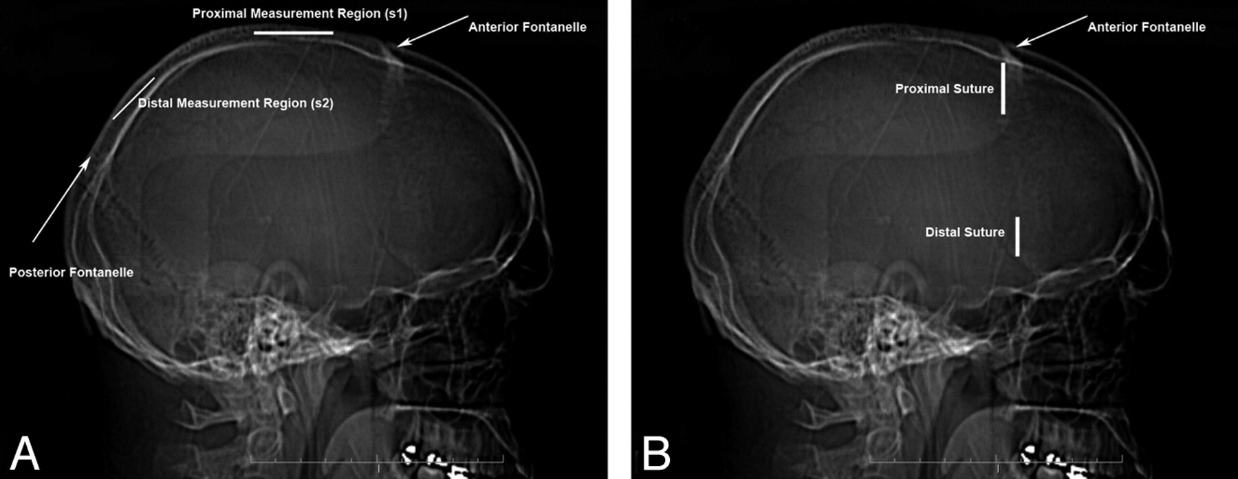 Normal Sagittal And Coronal Suture Widths By Using Ct Imaging
