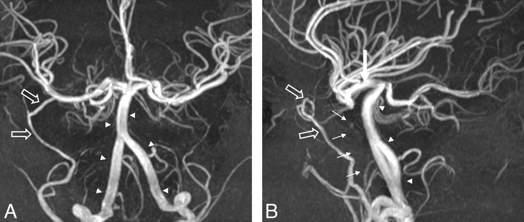 Bilateral Complete Labyrinthine Aplasia with Bilateral Internal Carotid