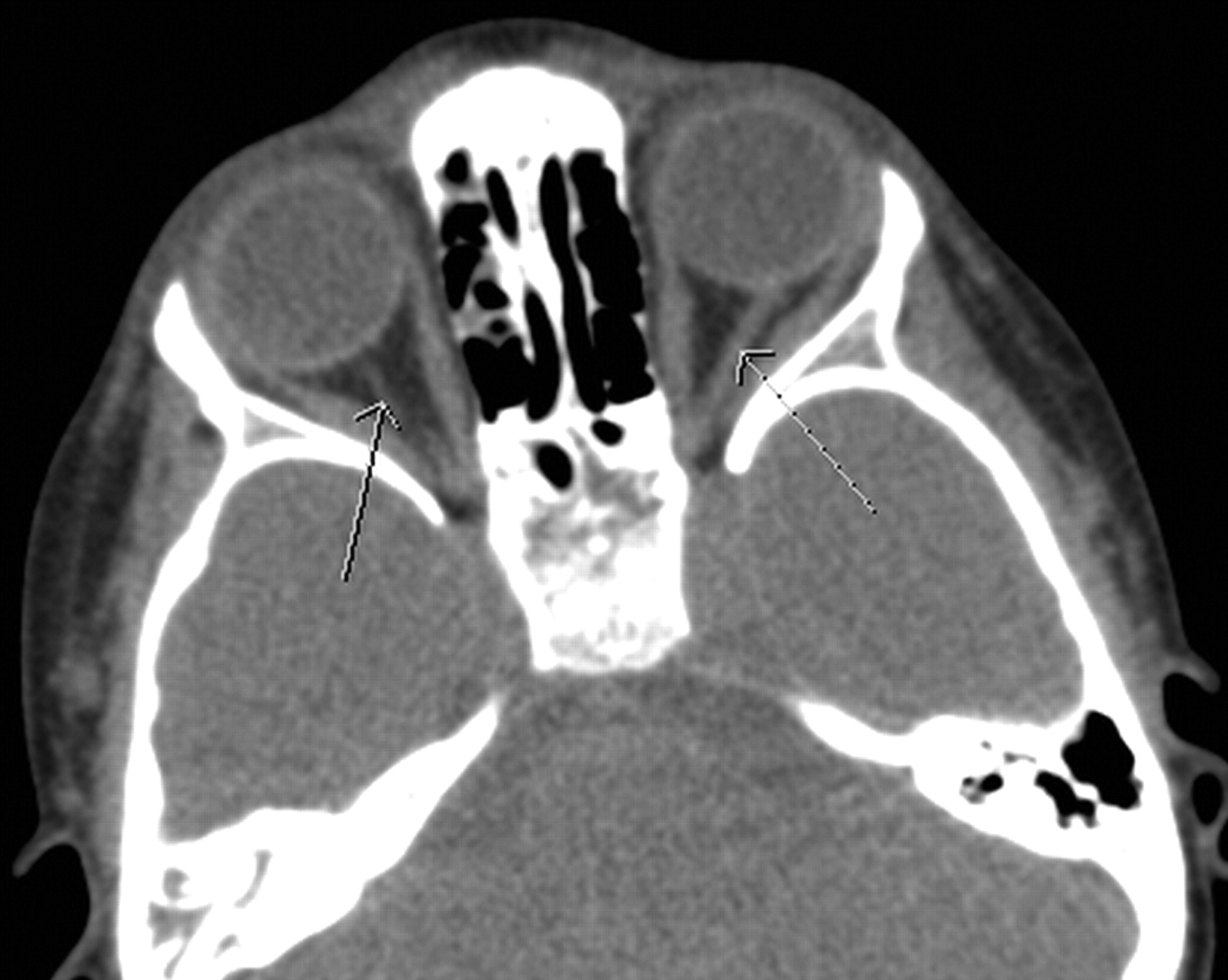 Anomalous Extraocular Muscles with Strabismus | American Journal of