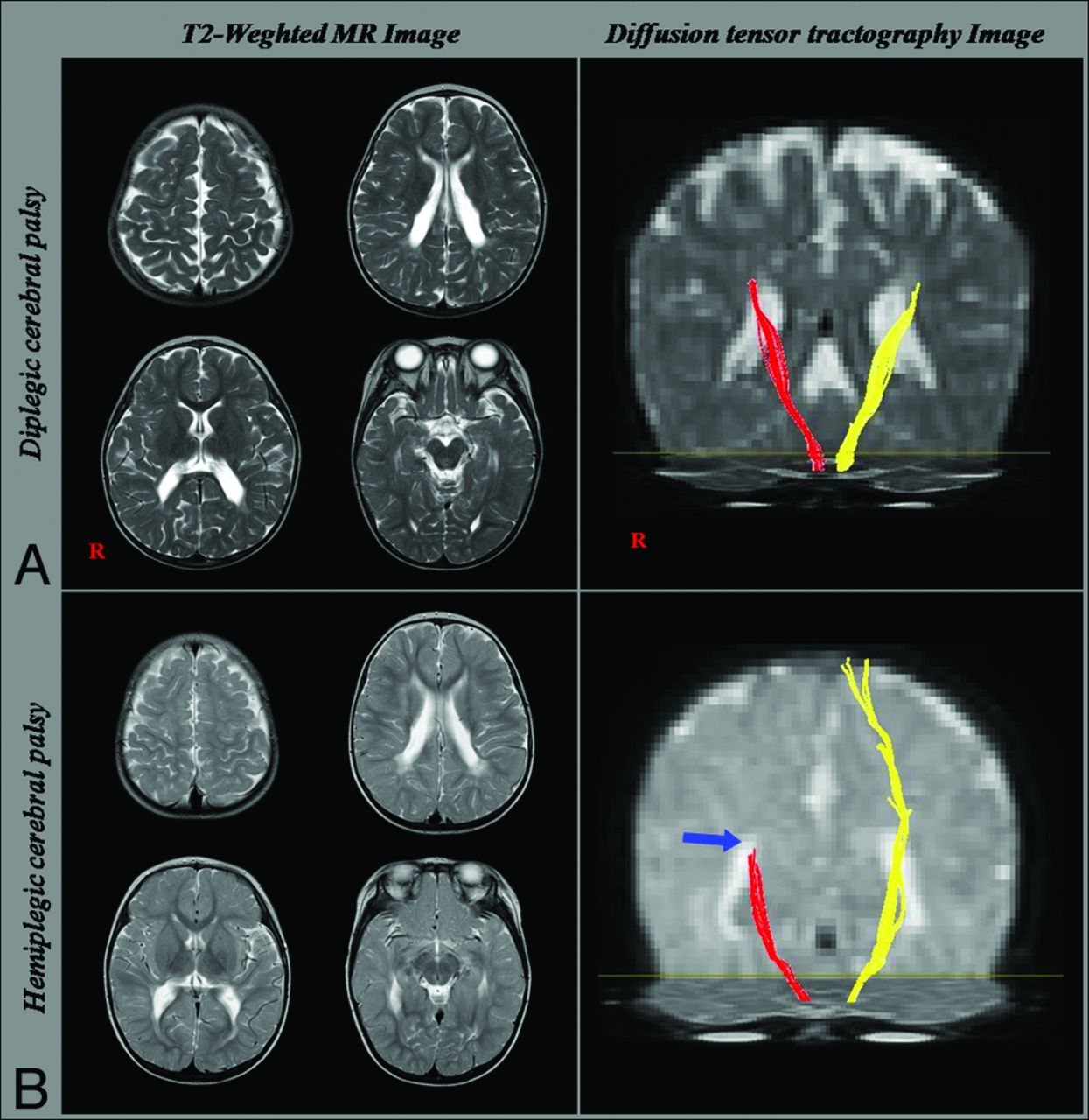 Diffusion Tensor Imaging–Demonstrated Differences between Hemiplegic