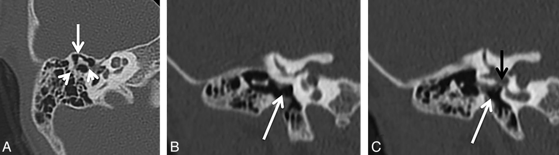 The Boomerang Malleus Incus Complex In Congenital Aural Atresia American Journal Of Neuroradiology