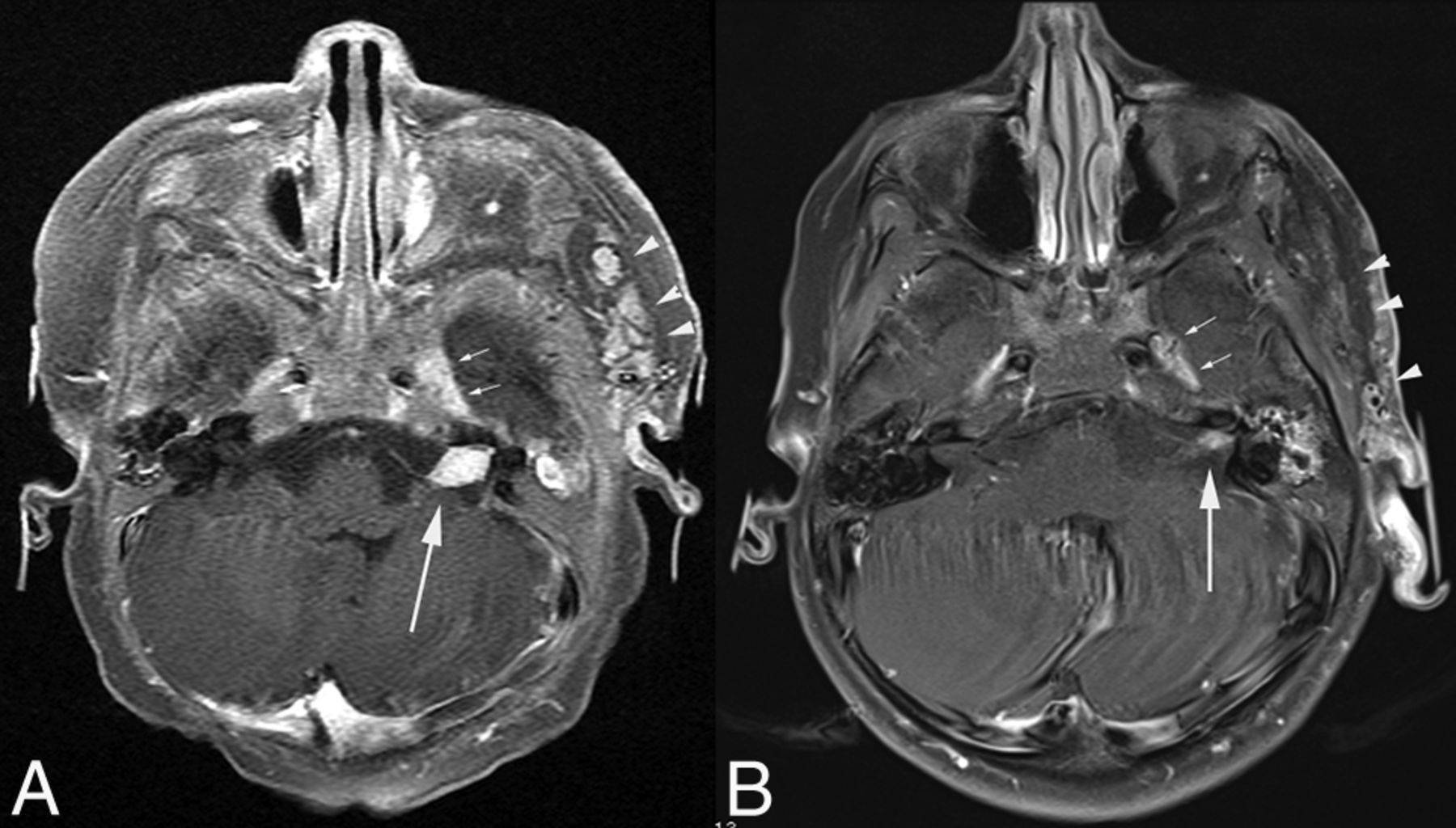 enlargement-of-the-internal-auditory-canal-and-associated-posterior