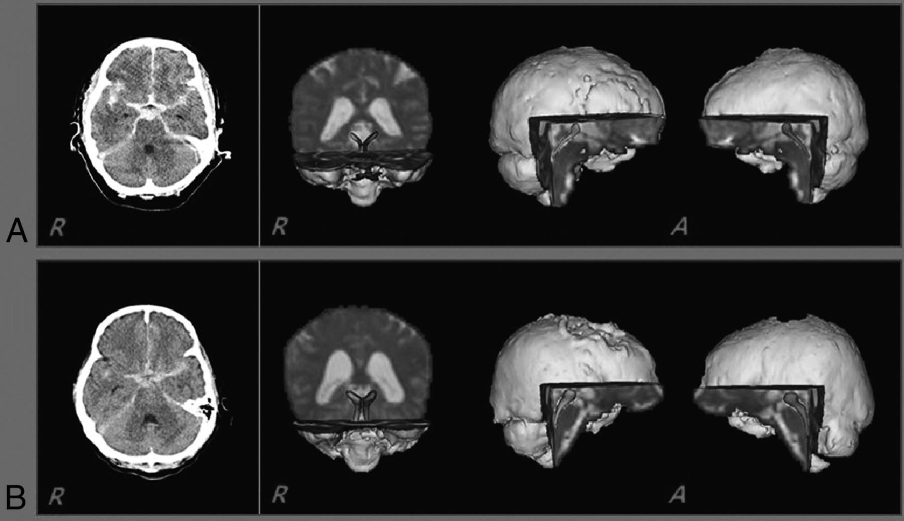 reticular formation