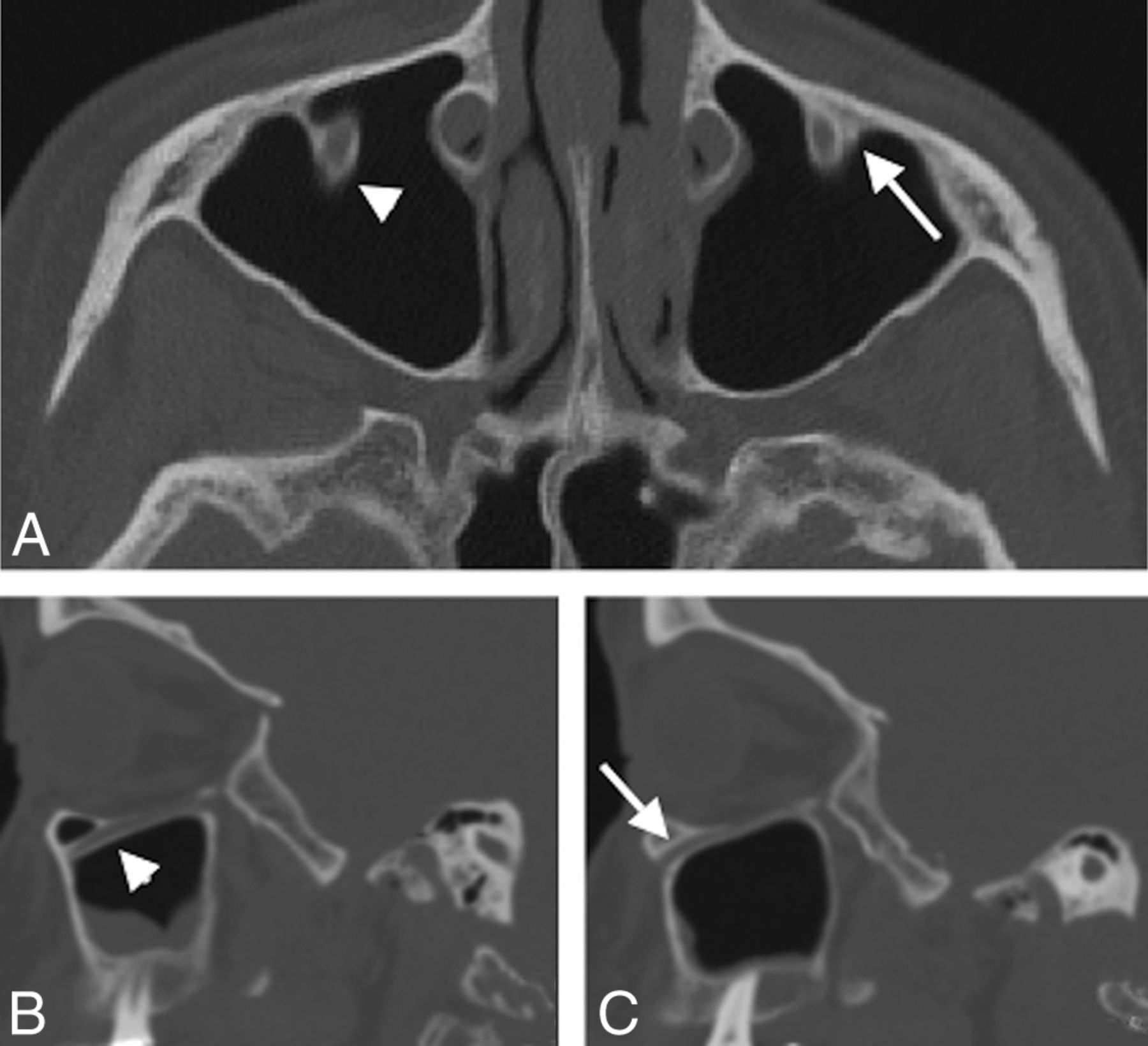 Protrusion Of The Infraorbital Nerve Into The Maxillary Sinus On Ct 8387