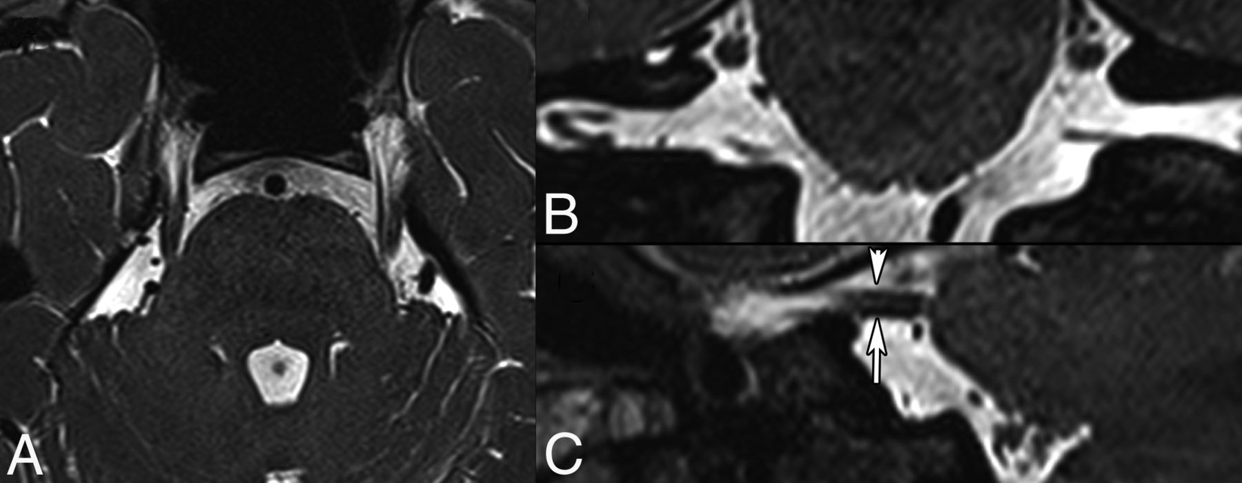 Imaging Of Neurovascular Compression Syndromes Trigeminal Neuralgia Hemifacial Spasm Vestibular Paroxysmia And Glossopharyngeal Neuralgia American Journal Of Neuroradiology