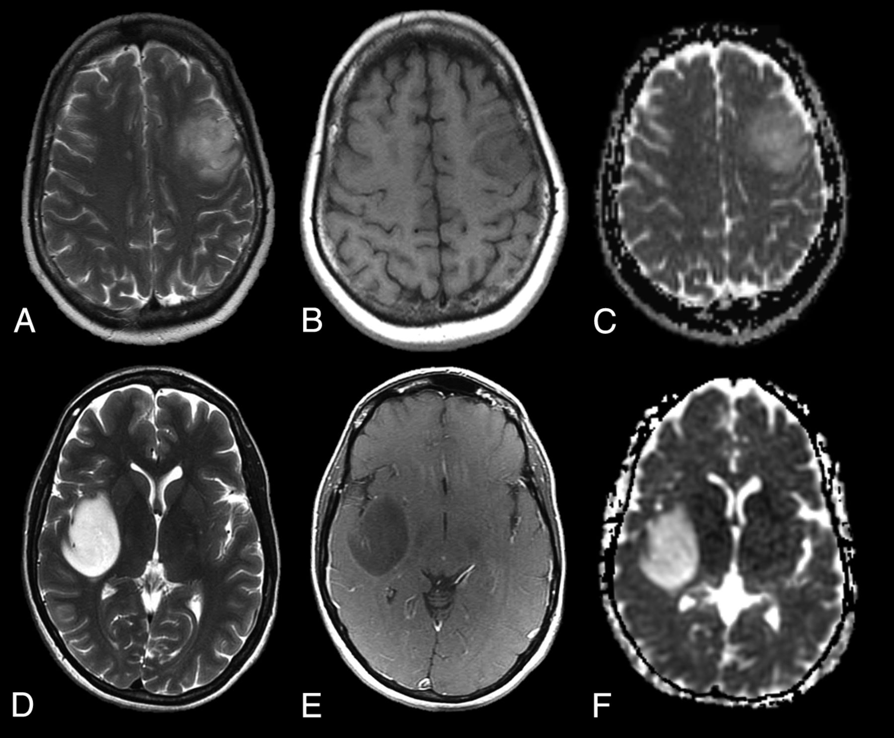 Genetically Defined Oligodendroglioma Is Characterized By Indistinct Tumor Borders At Mri American Journal Of Neuroradiology