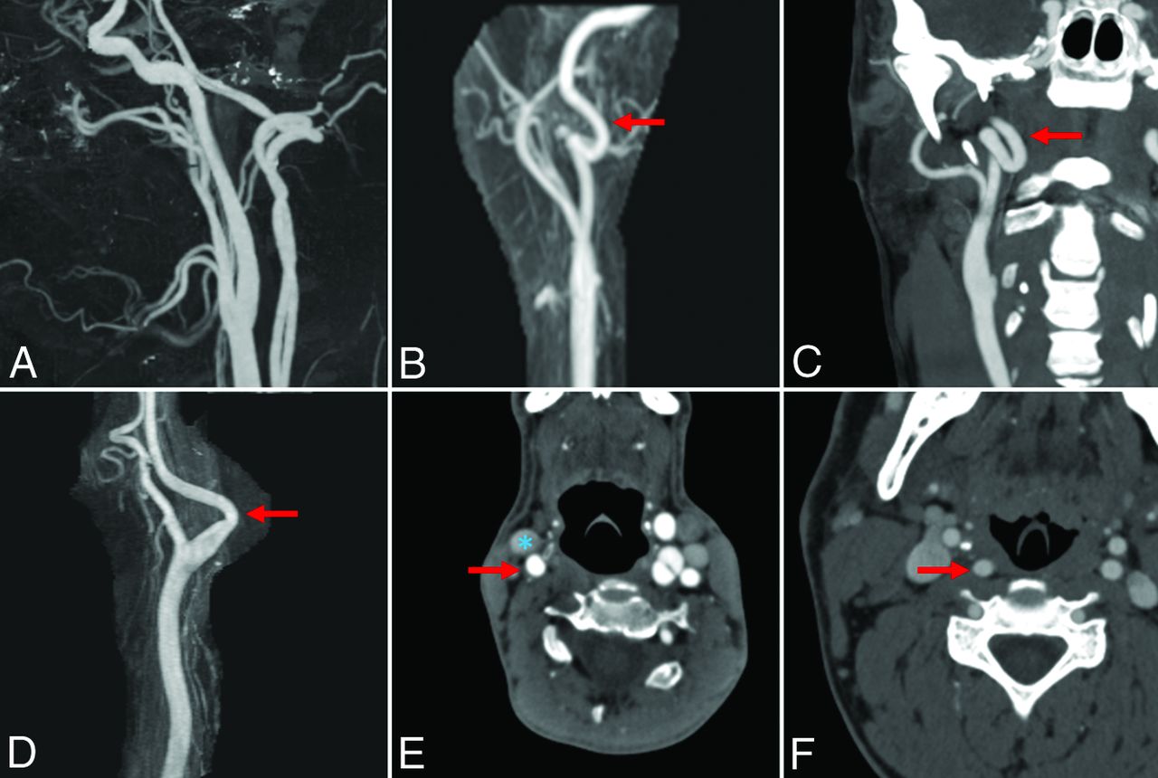 Carotid Artery Tortuosity Is Associated With Connective Tissue Diseases 