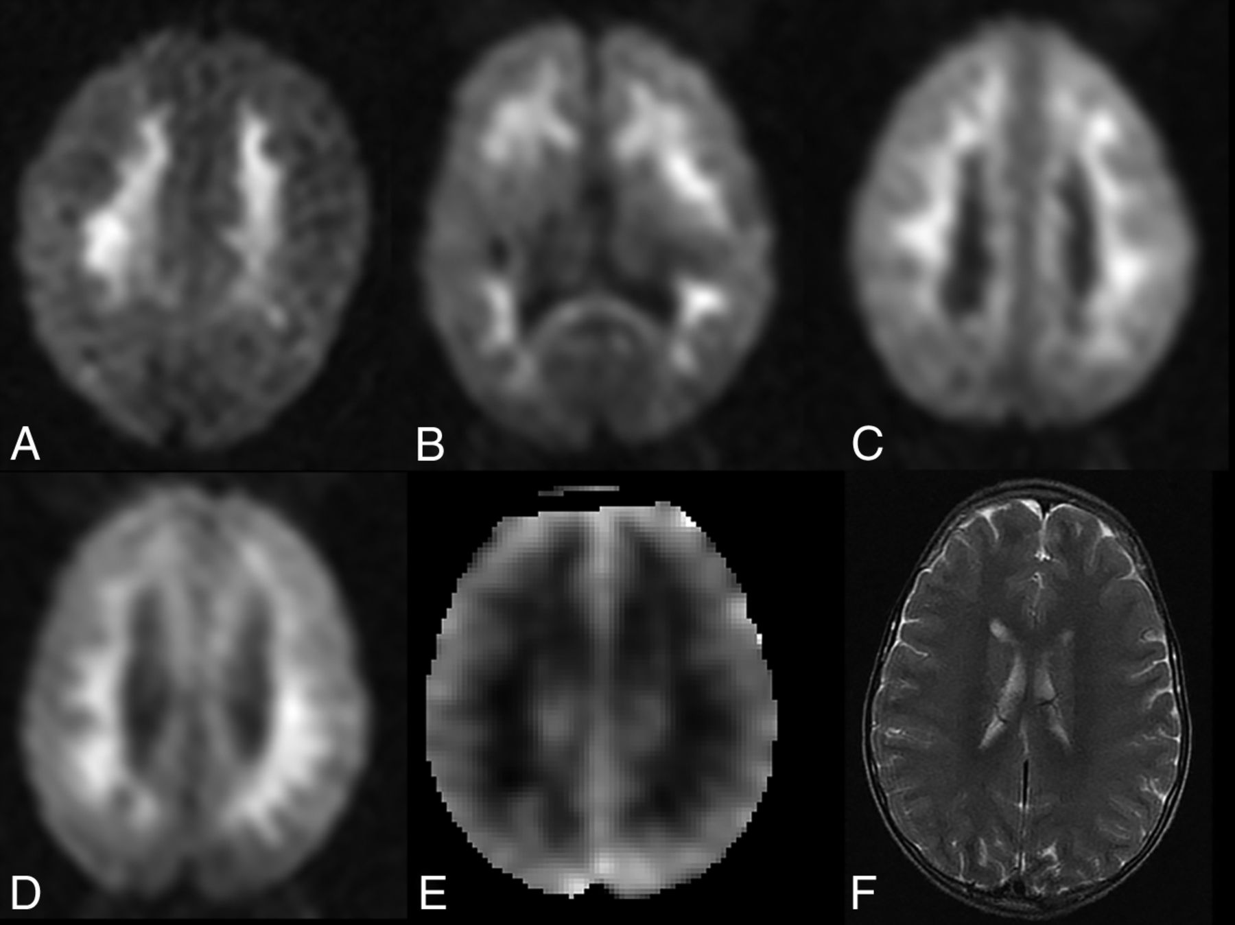 Diffusion Weighted Mr Imaging In A Prospective Cohort Of Children With