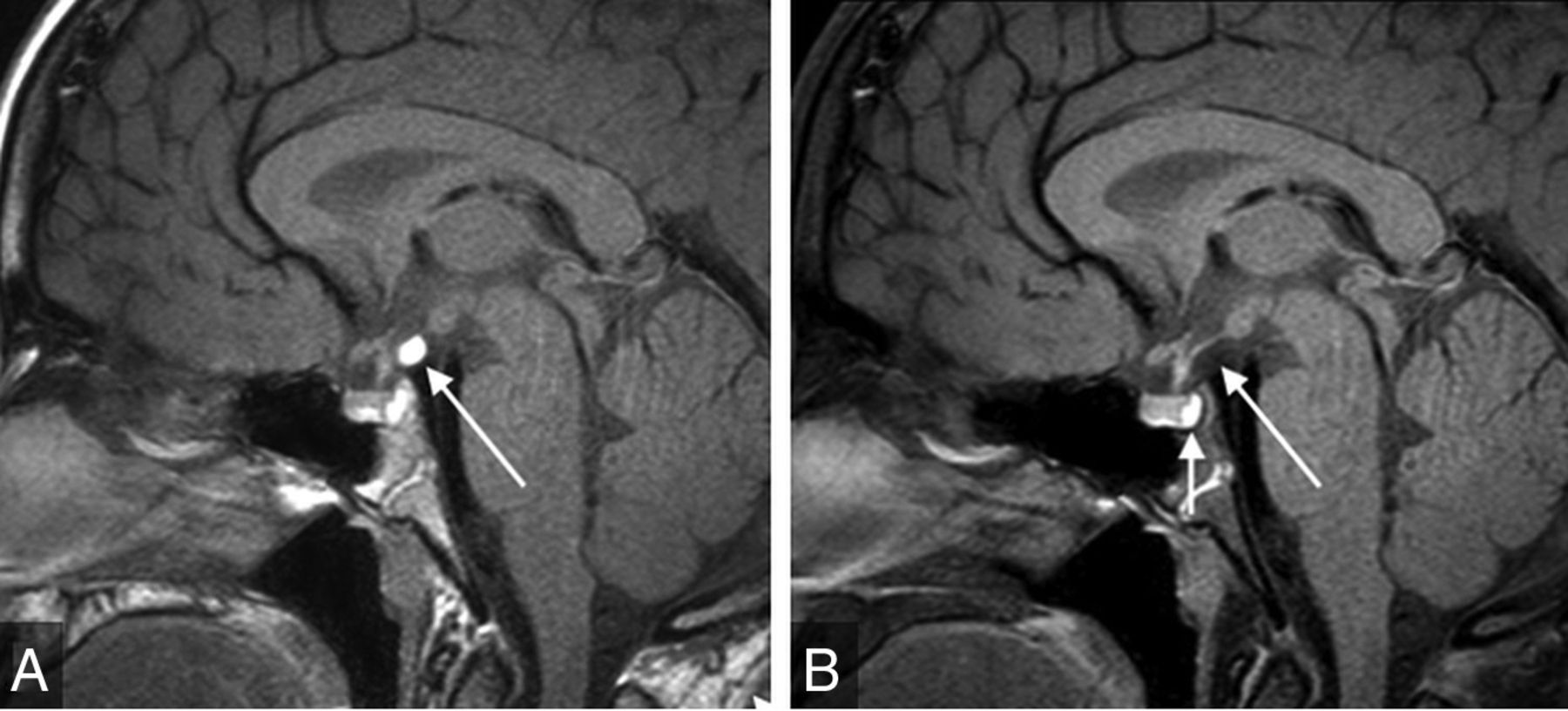 Noncontrast MRI Protocol for Selected Pediatric Pituitary ...