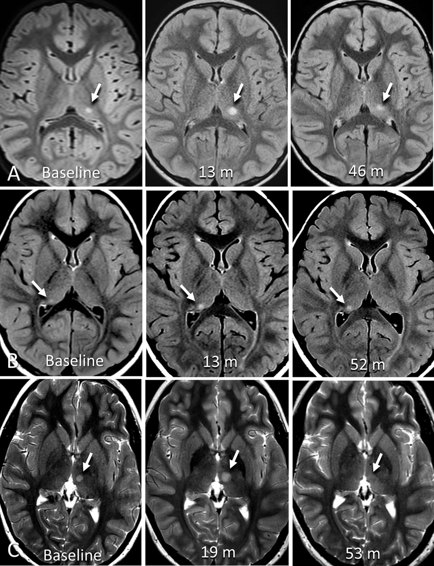 Incidental Thalamic Lesions Identified On Brain MRI In Pediatric And