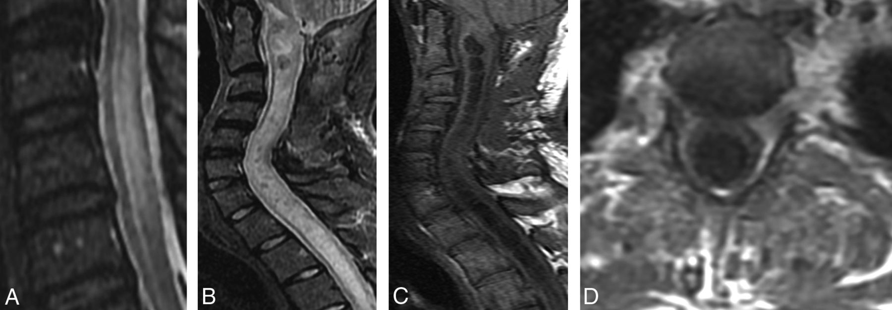 Spinal Coccidioidomycosis Mr Imaging Findings In 41 Patients American Journal Of Neuroradiology 
