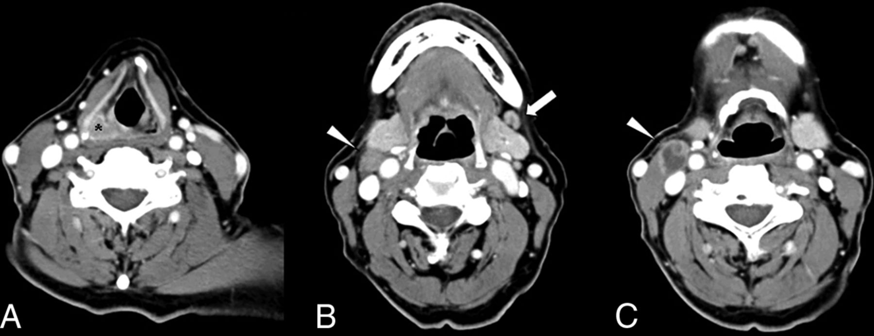 A Scoring System For Prediction Of Cervical Lymph Node Metastasis In