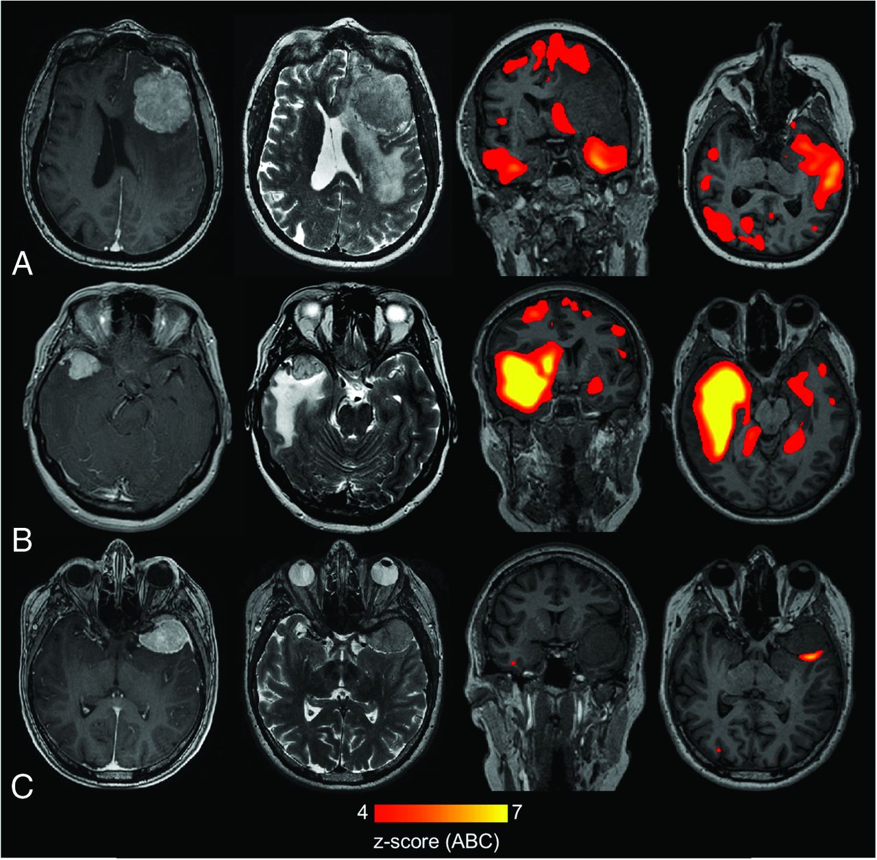 Perifocal Edema In Patients With Meningioma Is Associated With Impaired